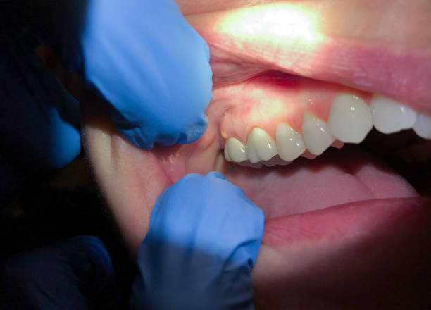 Best Emergency Gum Treatment in Basile, LA