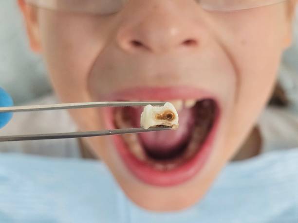 Best Emergency Treatment for Dental Infections or Abscesses in Basile, LA